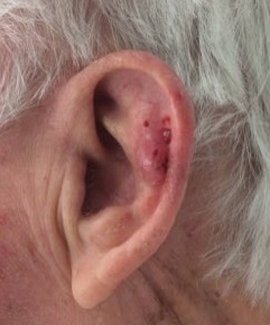 Atypical Fibroxanthoma