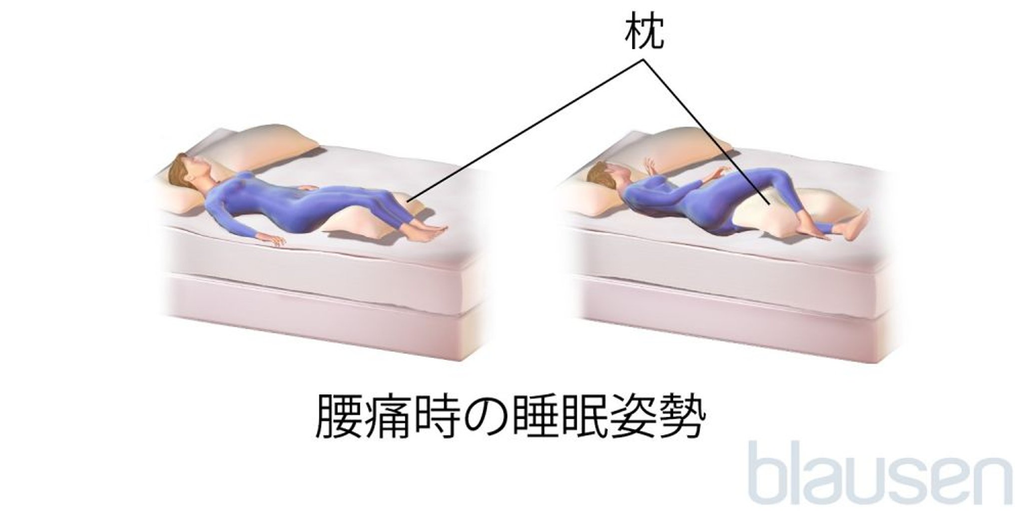 背部痛がある場合の睡眠時の姿勢