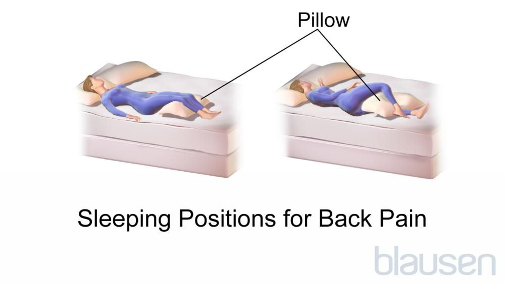 Posições para dormir quando se tem dor nas costas