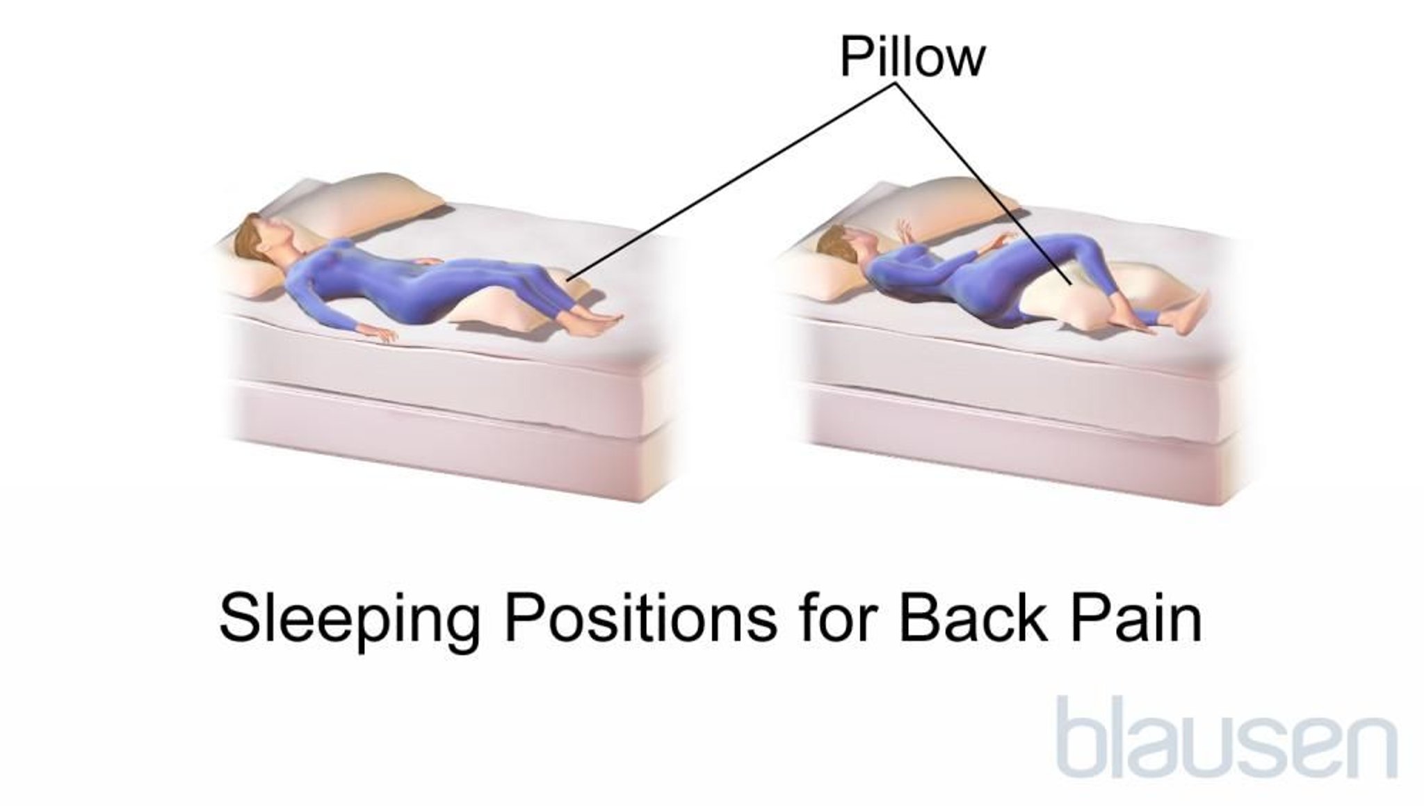 背痛的睡眠体位