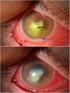 Bacterial Corneal Ulcer