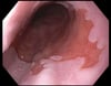 Barrett Esophagus