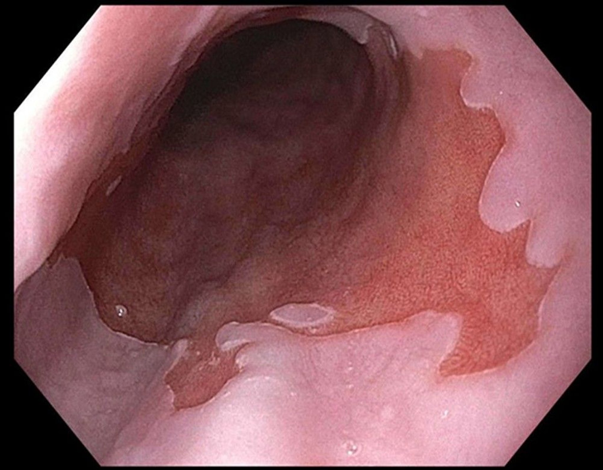 Barrett Esophagus