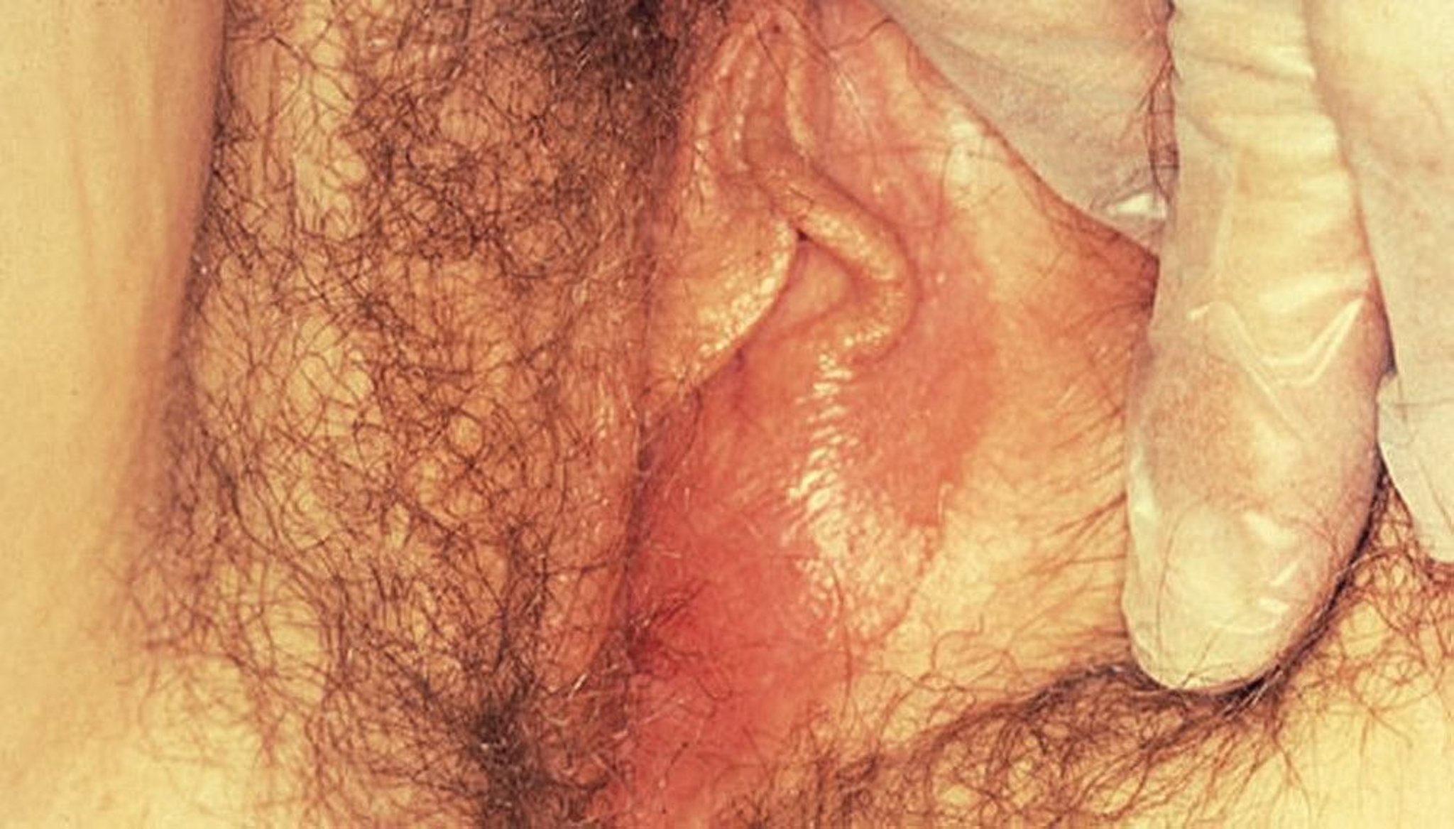 Bartholin Gland Cyst