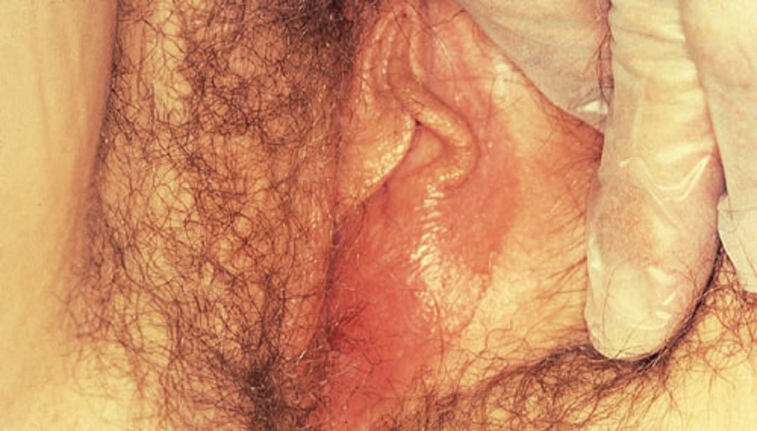 बार्थोलिन ग्रंथि पुटी