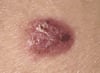 Nodular Basal Cell Carcinoma (1)