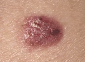 Carcinome basocellulaire nodulaire
