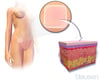 Birth Control Patch