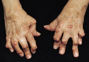 Knopflochdeformation bei rheumatoider Arthritis