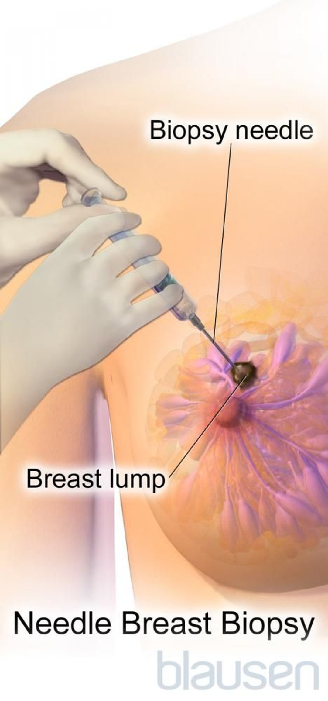 Needle Breast Biopsy