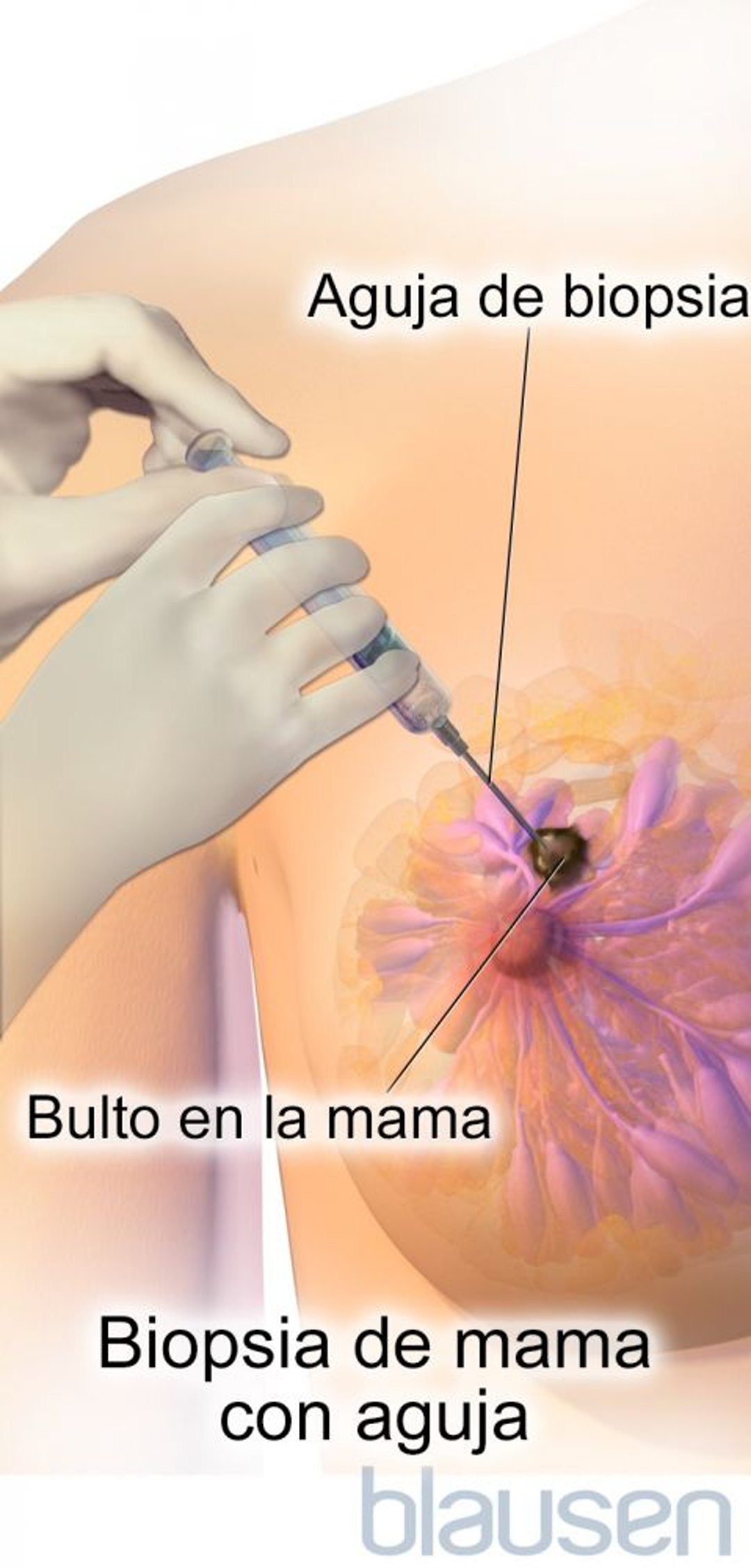 Biopsia de la mama por punción