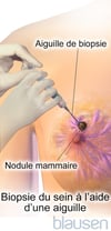 Biopsie du sein au trocart