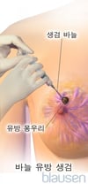 바늘 유방 생검