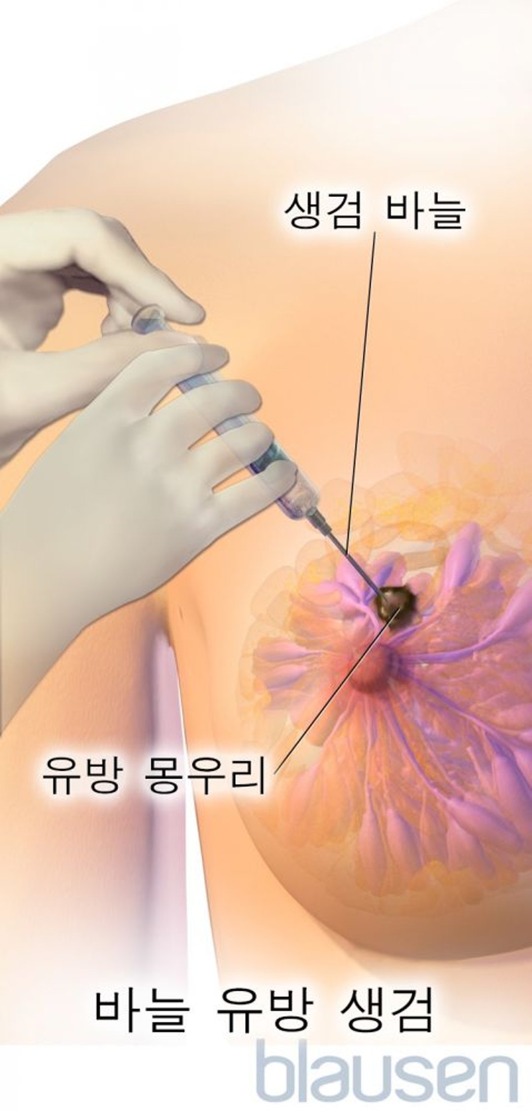 바늘 유방 생검