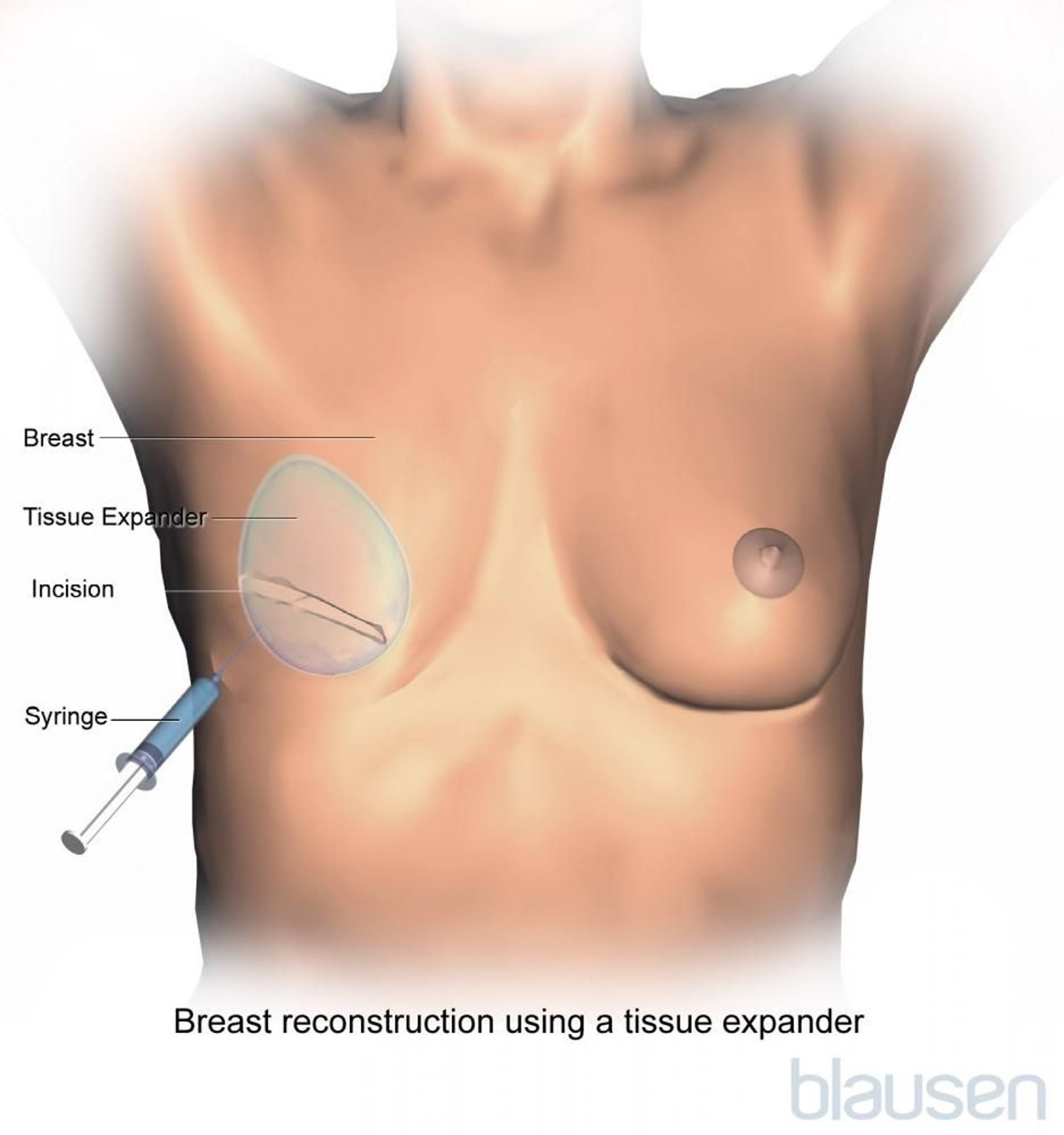 Breast Reconstruction Expander