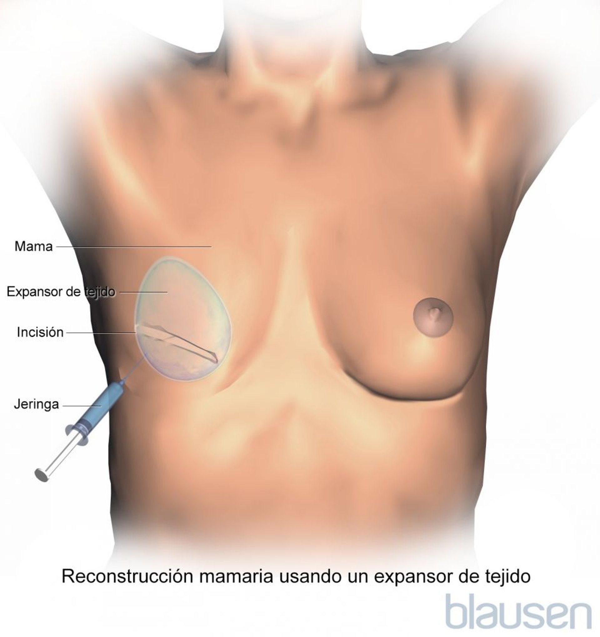 Expansor de reconstrucción mamaria