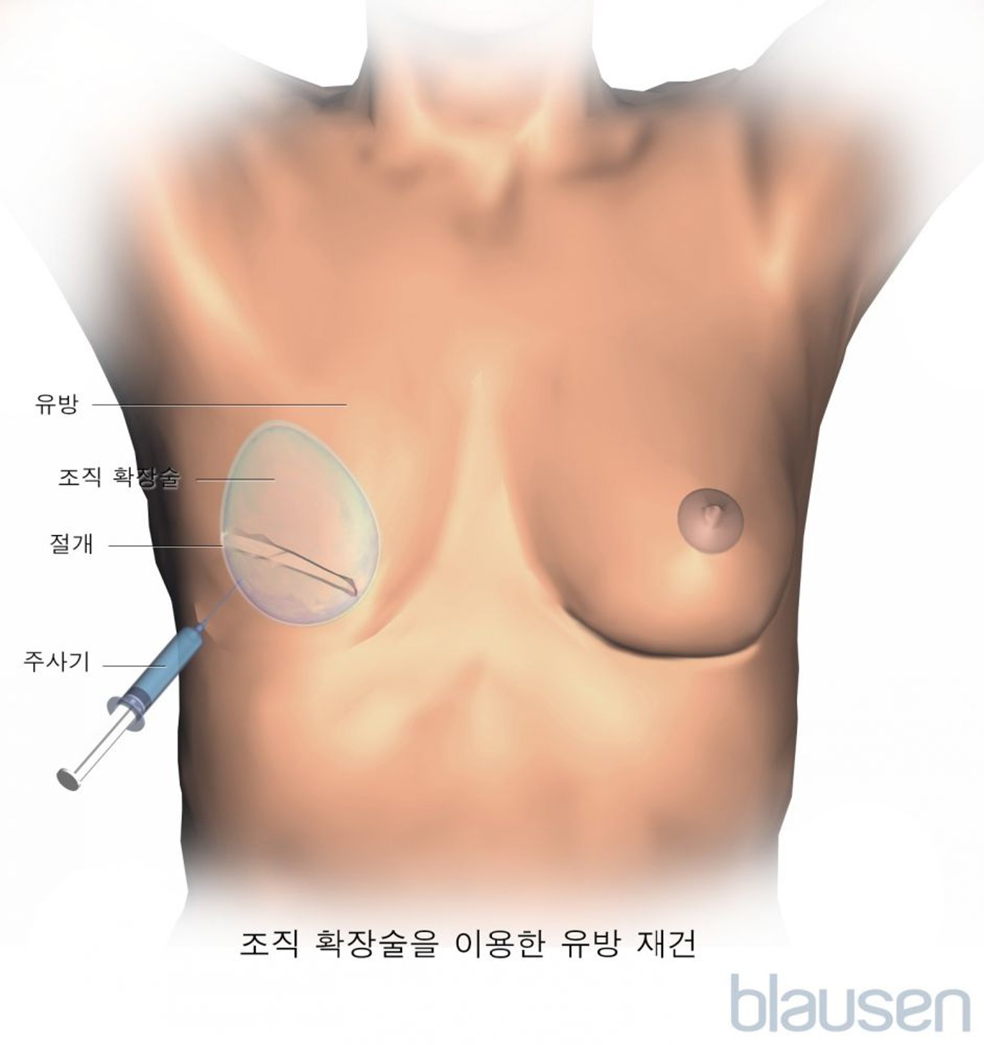 유방 재건 확장기
