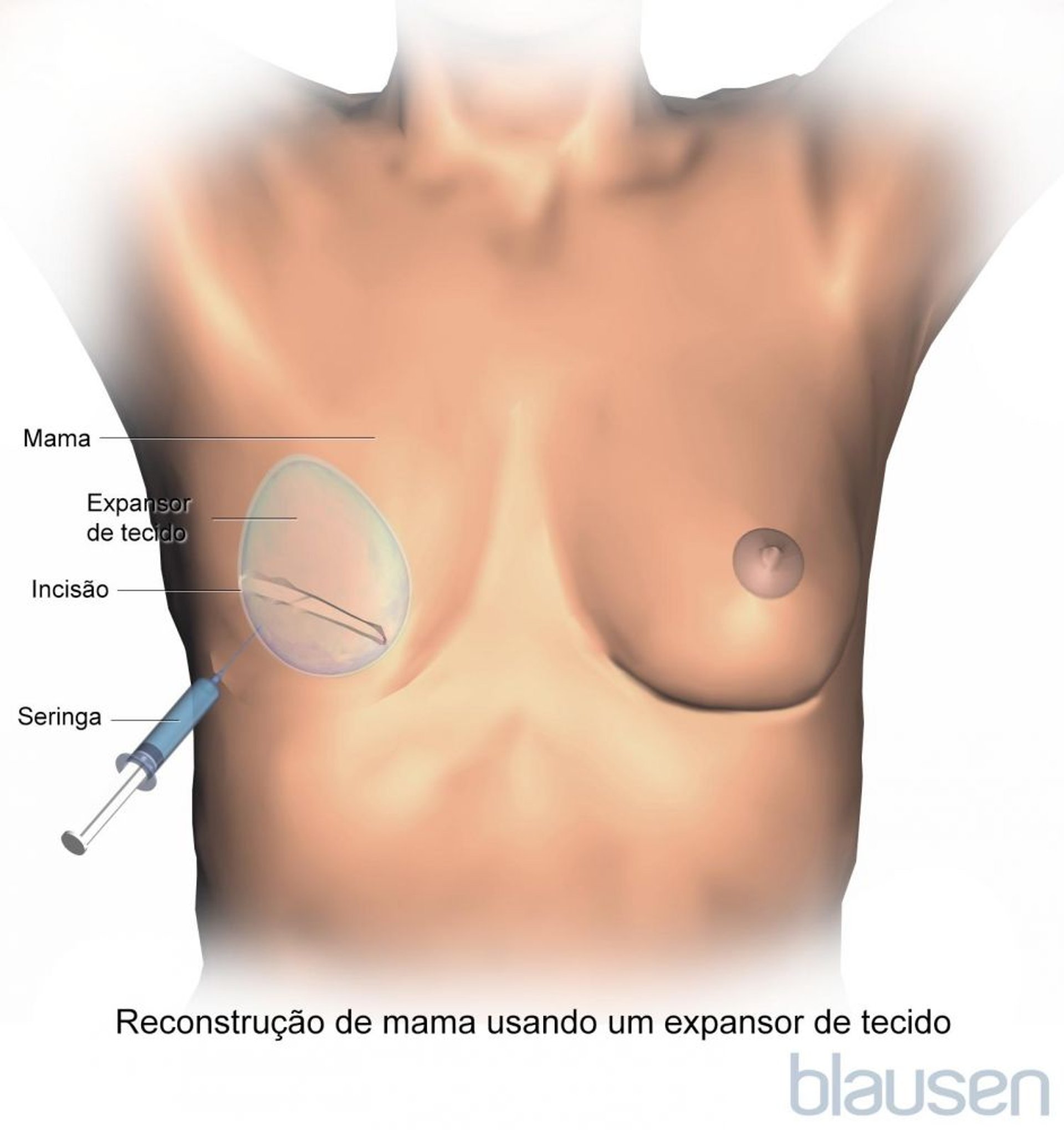Expansor para cirurgia de reconstrução da mama