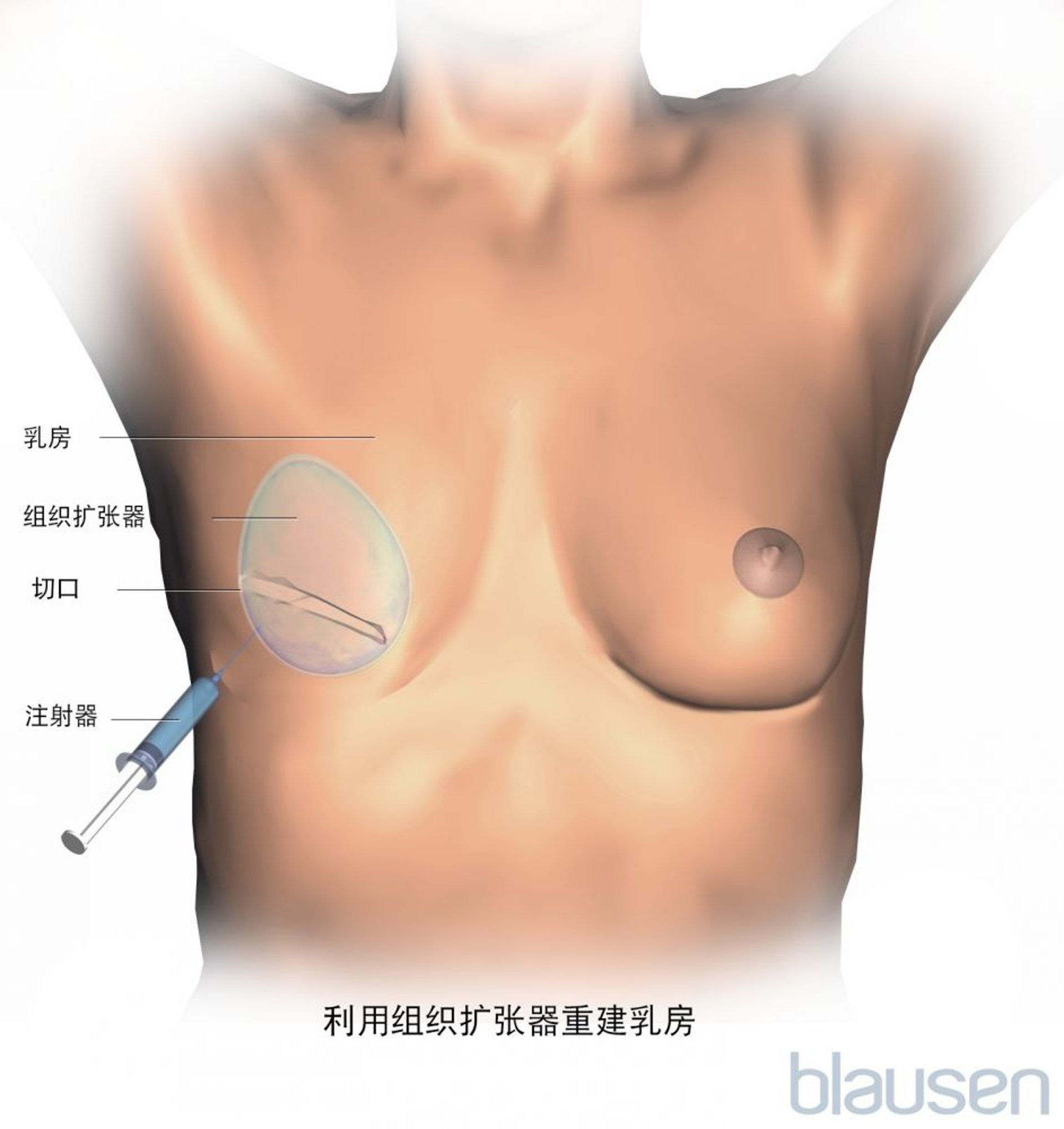 乳房重建扩张器