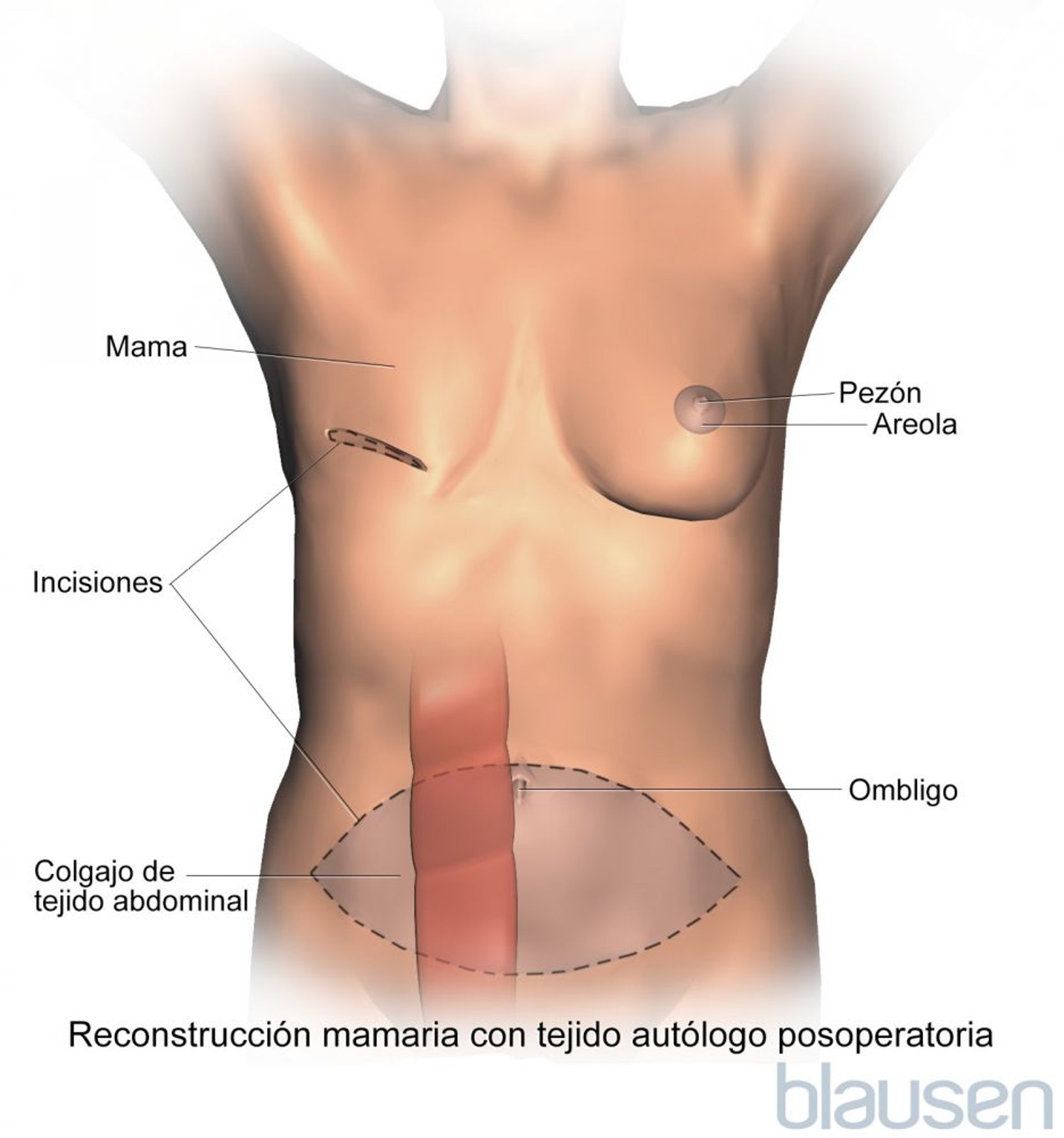 Procedimiento para realizar una reconstrucción mamaria con el colgajo del músculo transverso del recto abdominal (TRAM, por sus siglas en inglés)