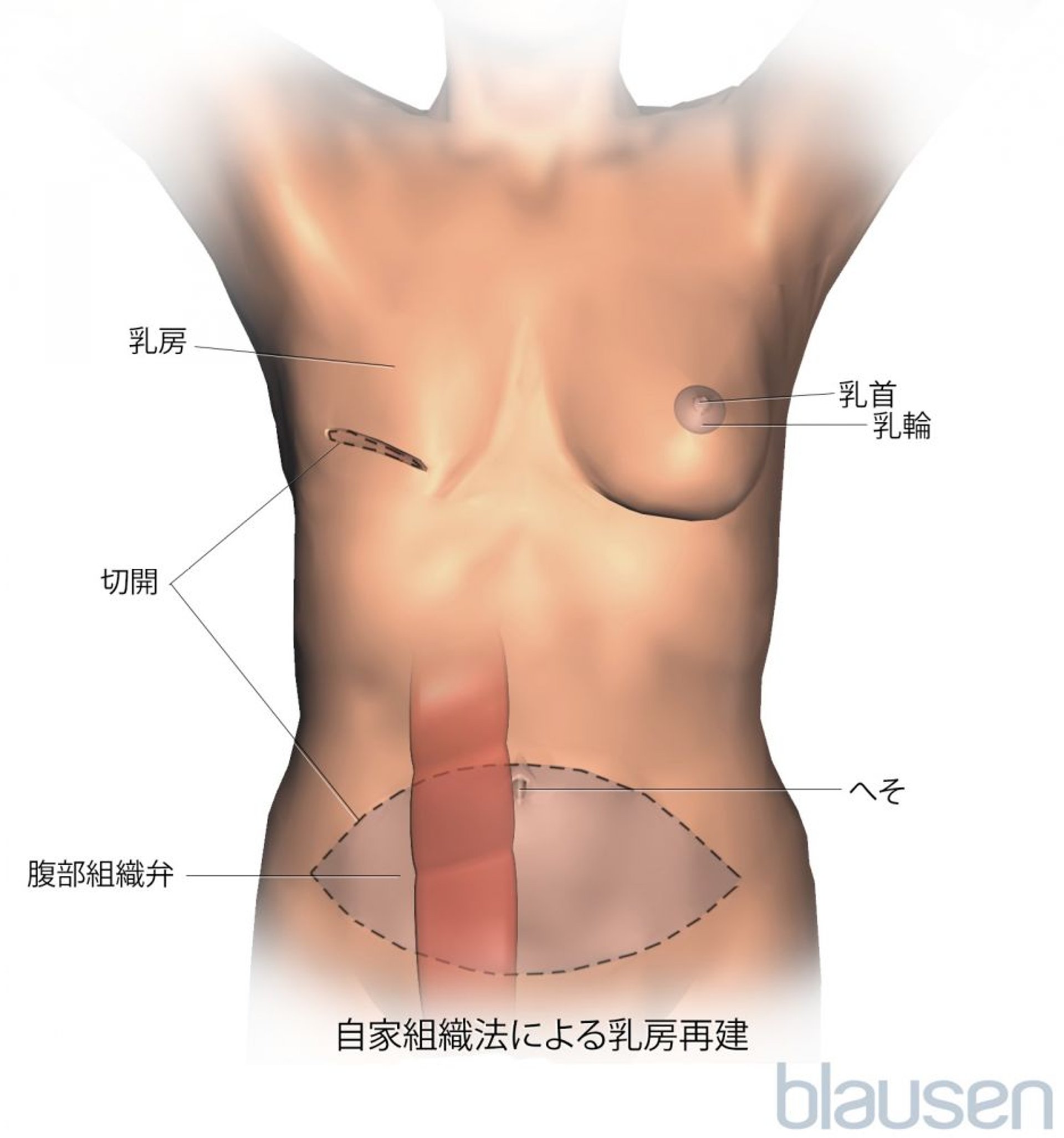 横行腹直筋（TRAM）皮弁を用いた乳房再建術