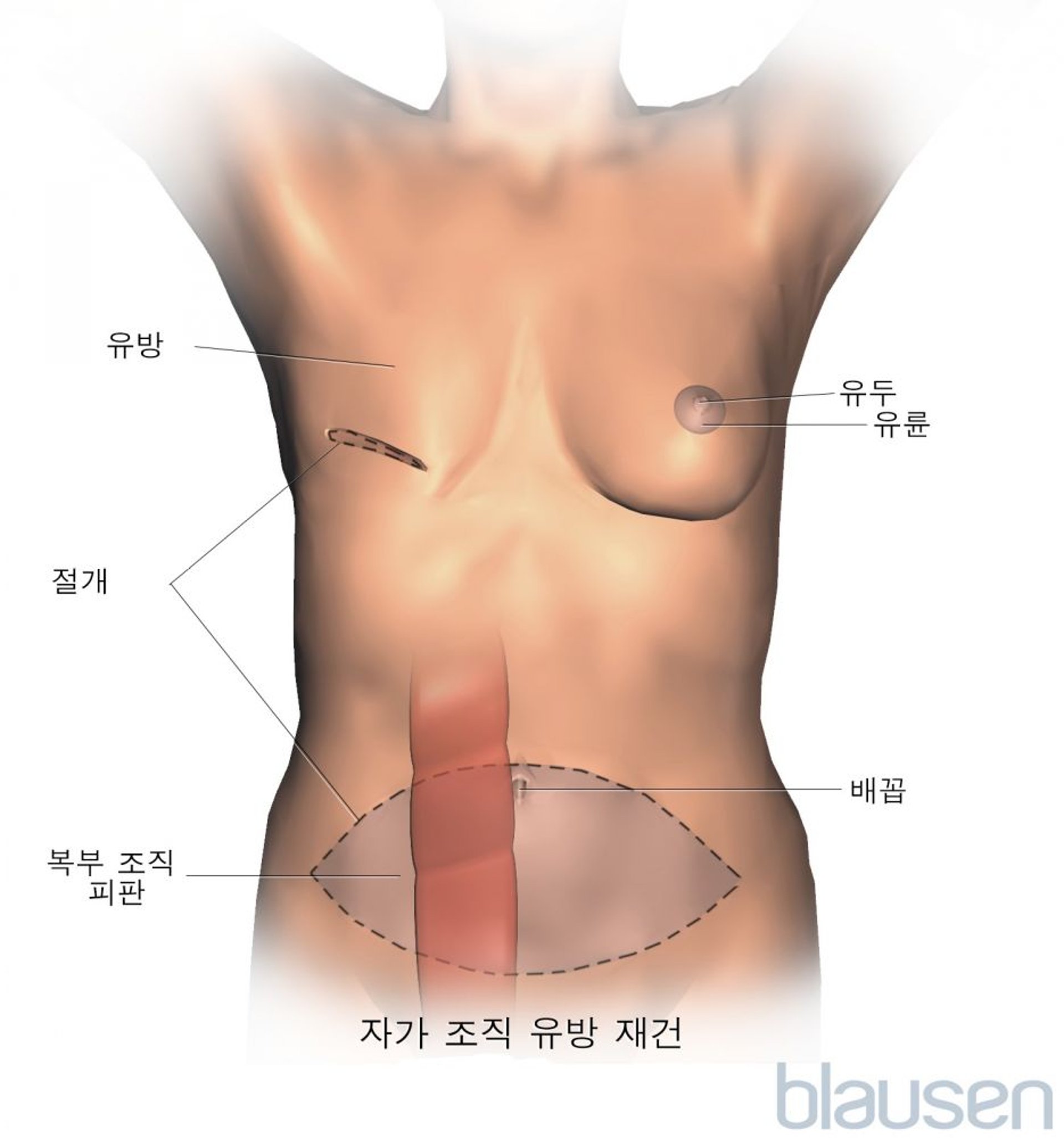 횡복직근(TRAM) 피판 절차를 이용한 유방 재건