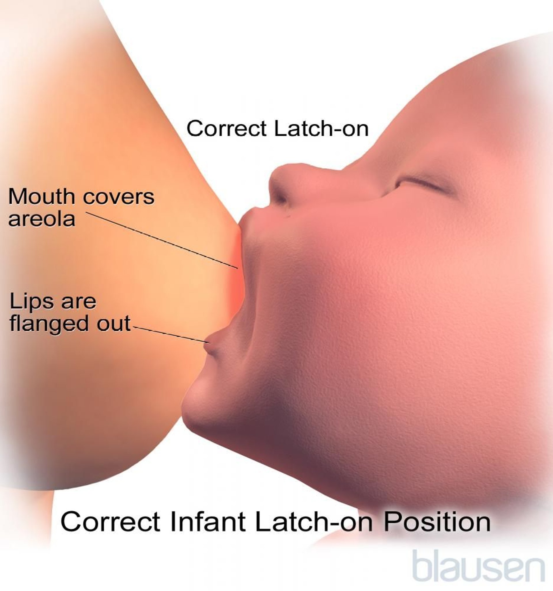 Correct Latch-On Position for Breastfeeding
