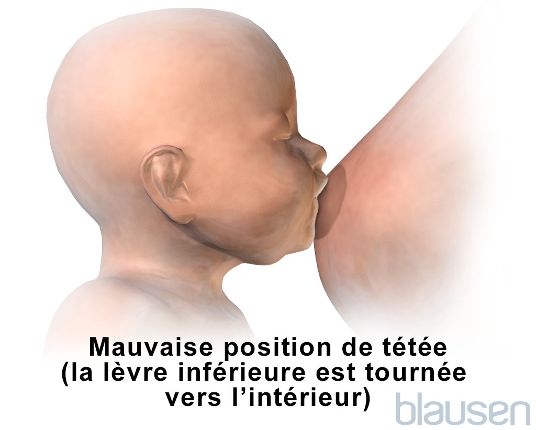 Mauvaise position au sein pour l’allaitement