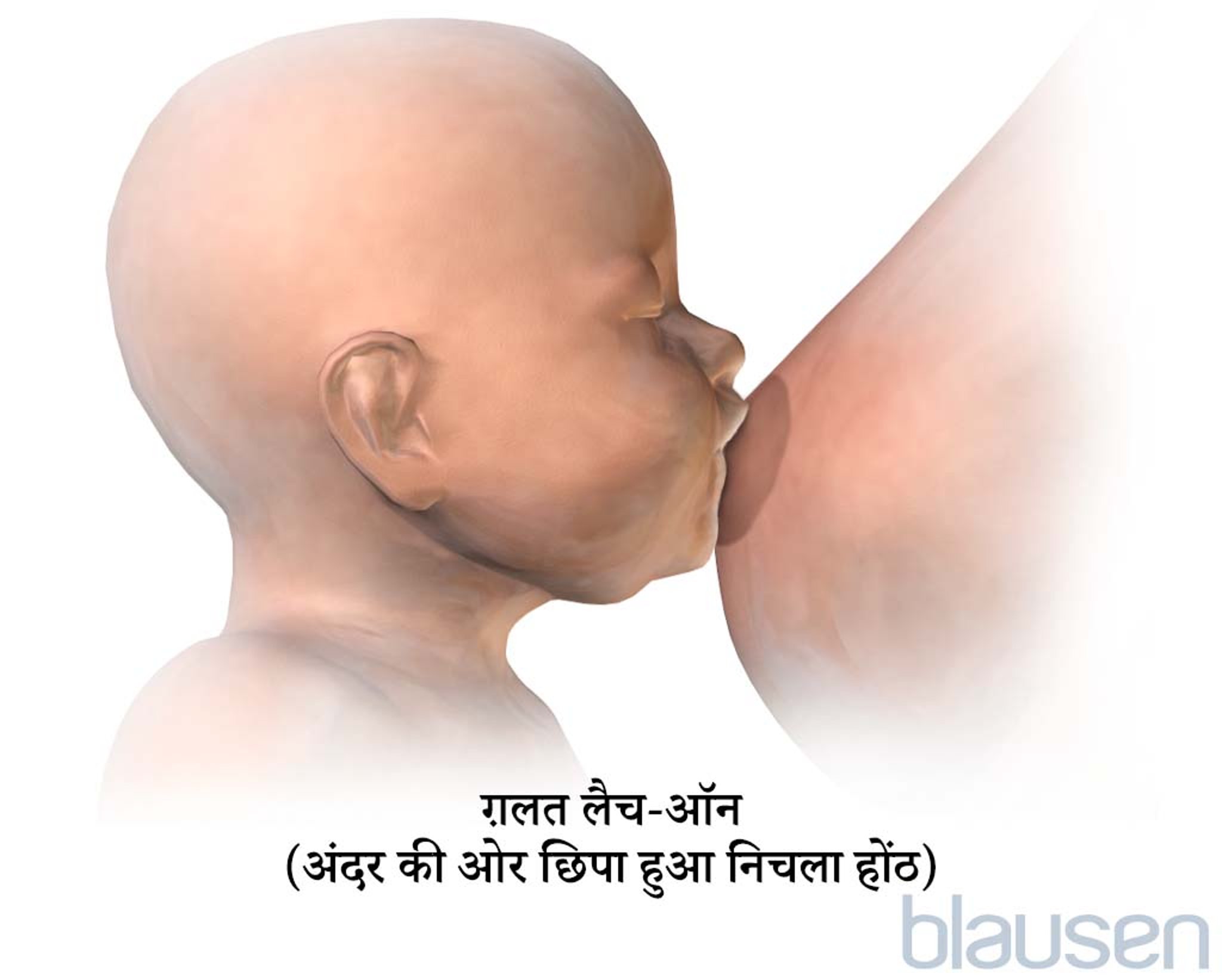 स्तनपान करवाने के लिए गलत लैच-ऑन पोजीशन