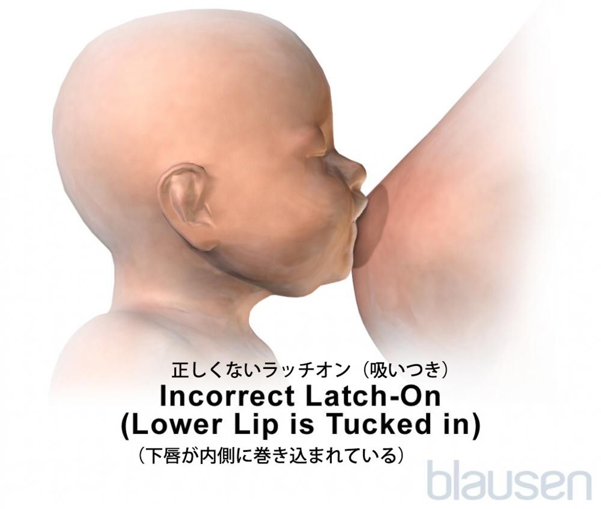 授乳時の乳児の正しくないラッチオン（吸いつき）