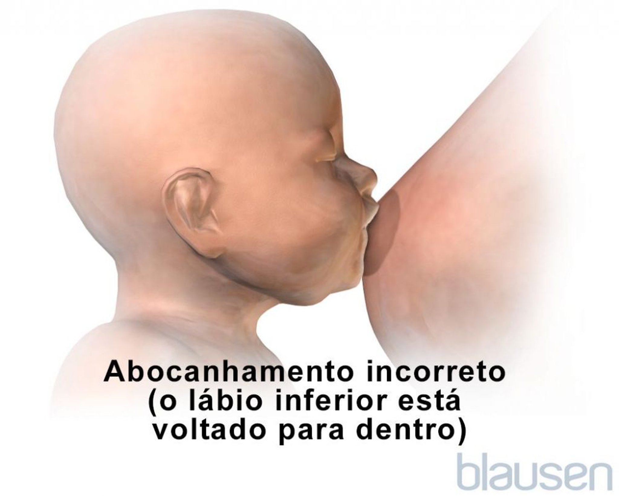 Posição incorreta de pega para a amamentação