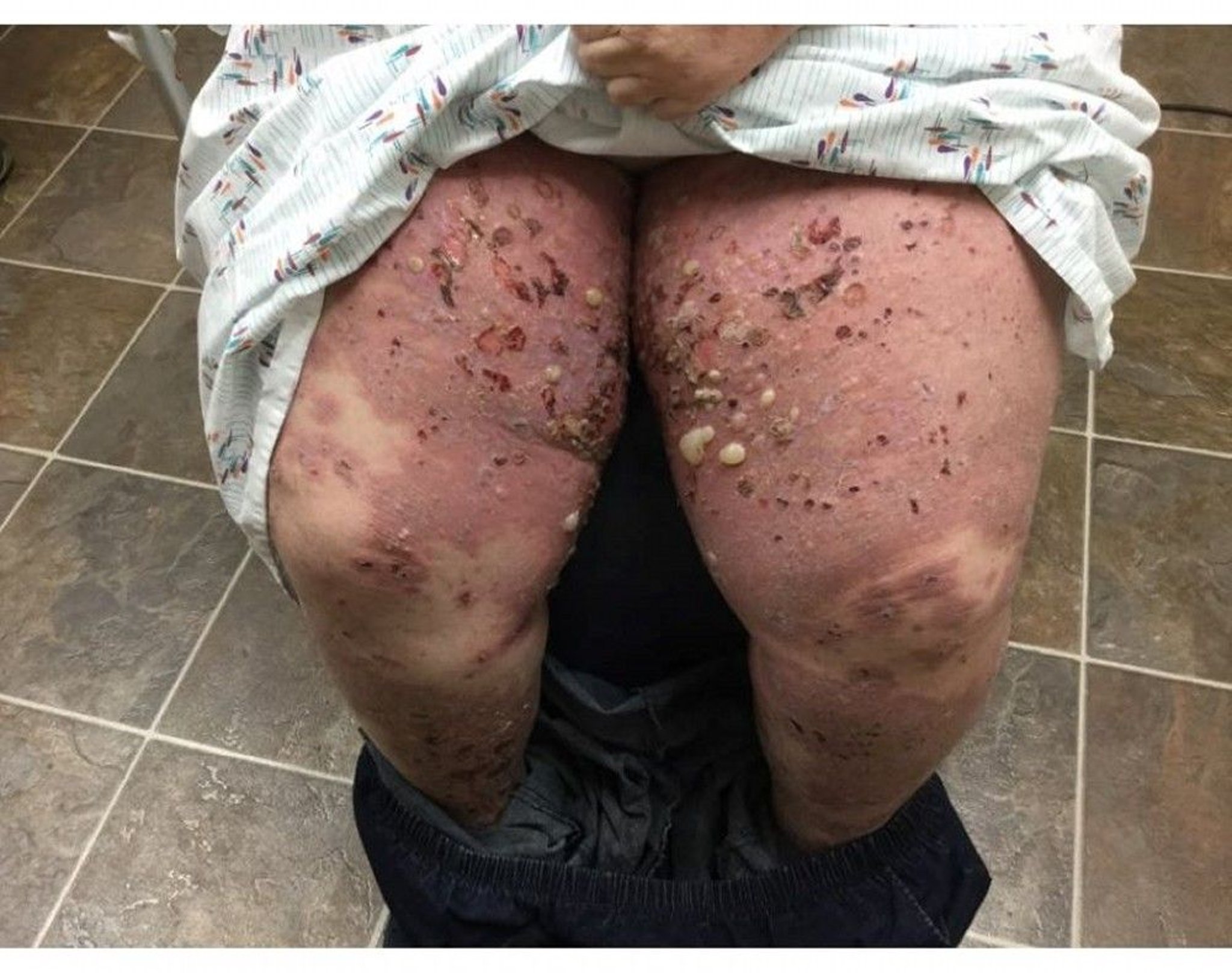 Bullous Pemphigoid on the Legs