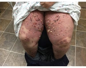 Pemphigoïde bulleuse sur les jambes