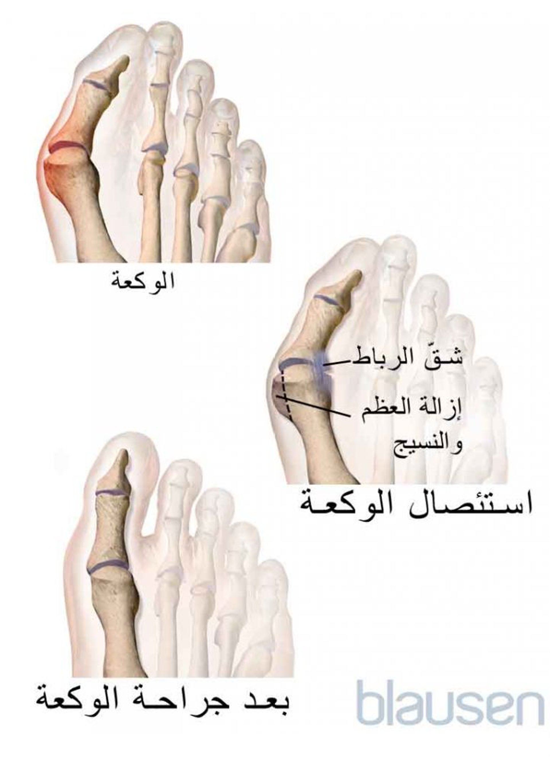 استئصال الوكعة