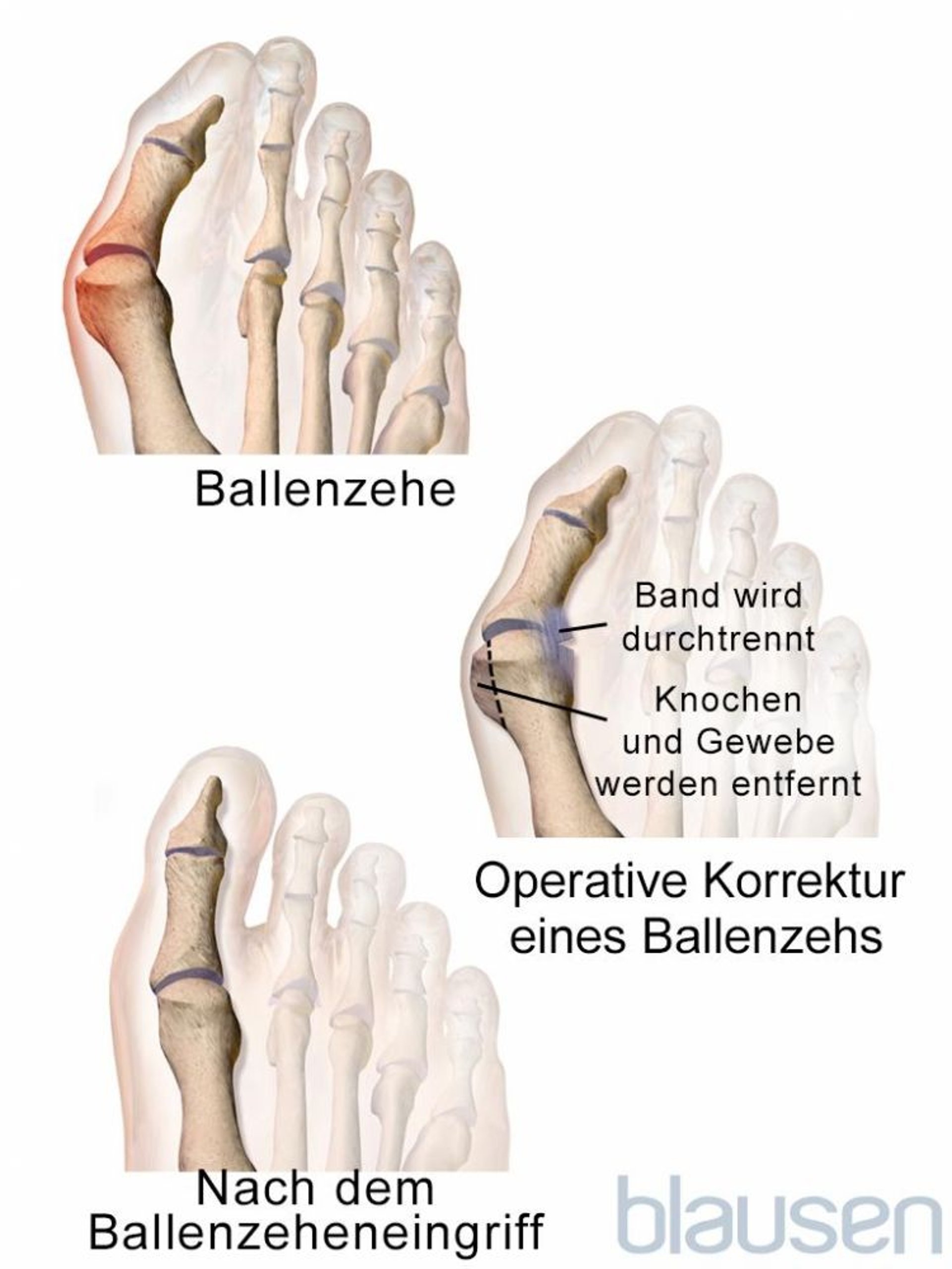 Operative Korrektur eines Ballenzehs