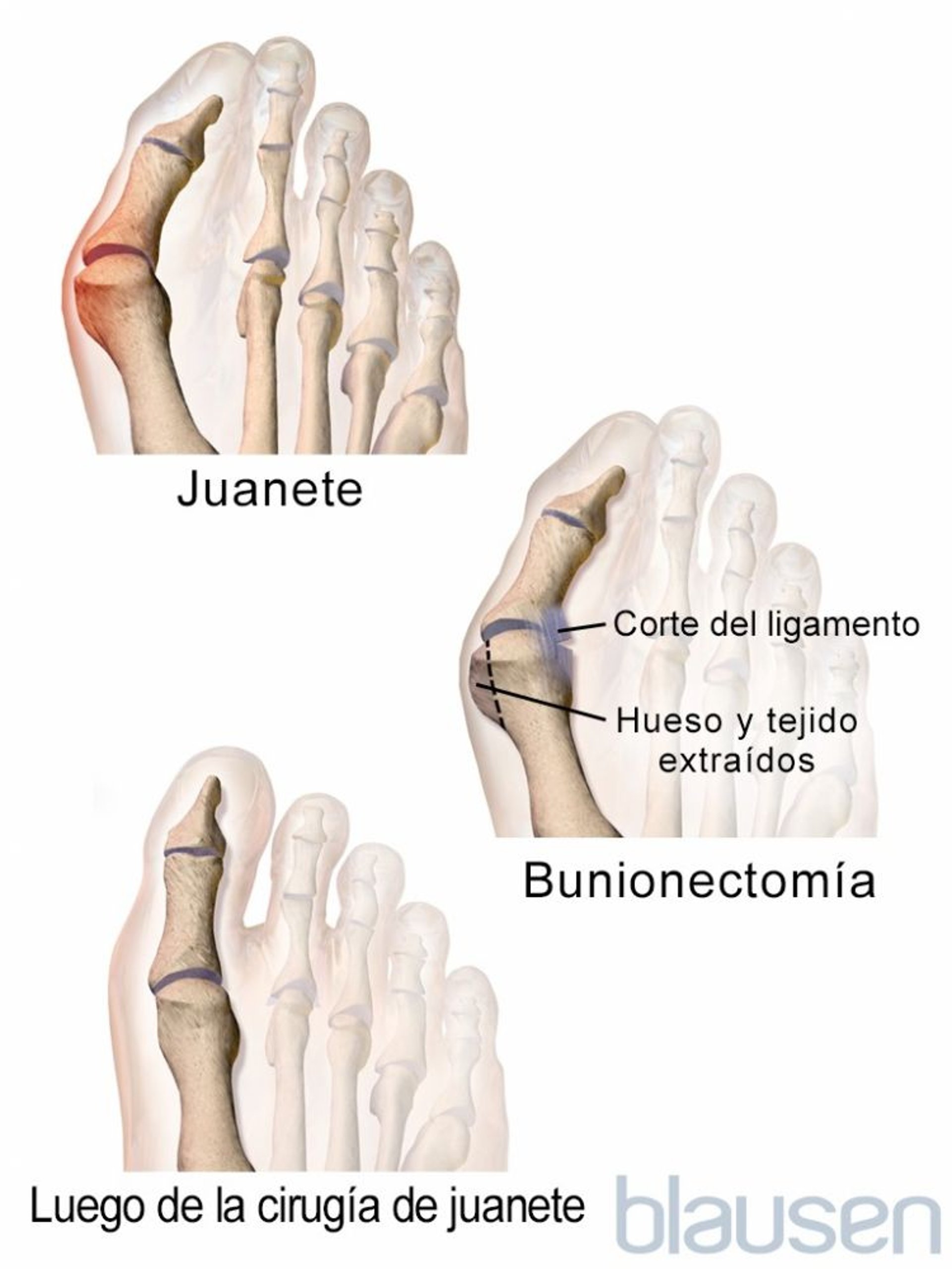 Exostectomía del primer dedo del pie o corrección de juanetes