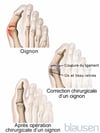 Ablation d’un oignon