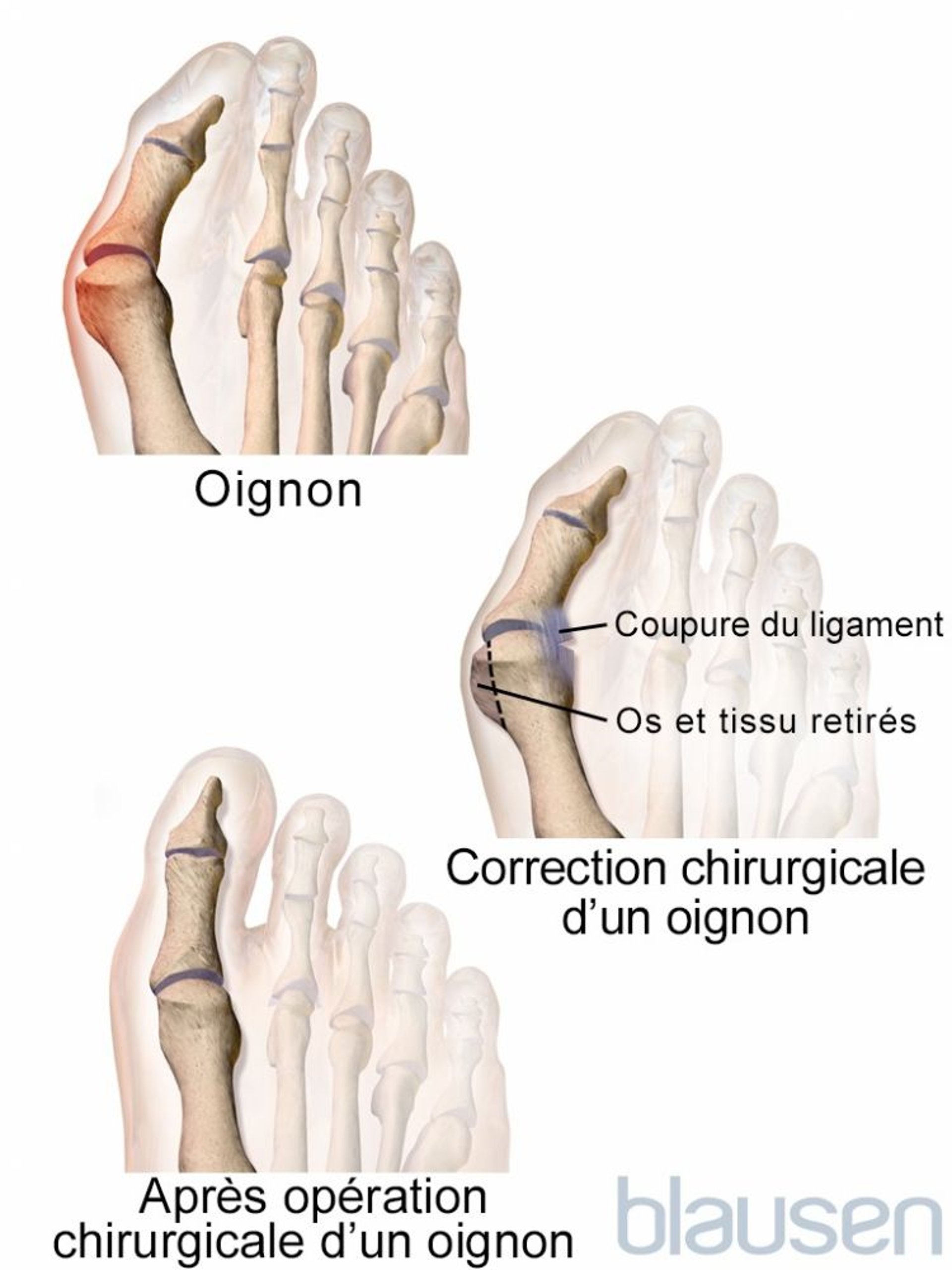 Ablation d’un oignon