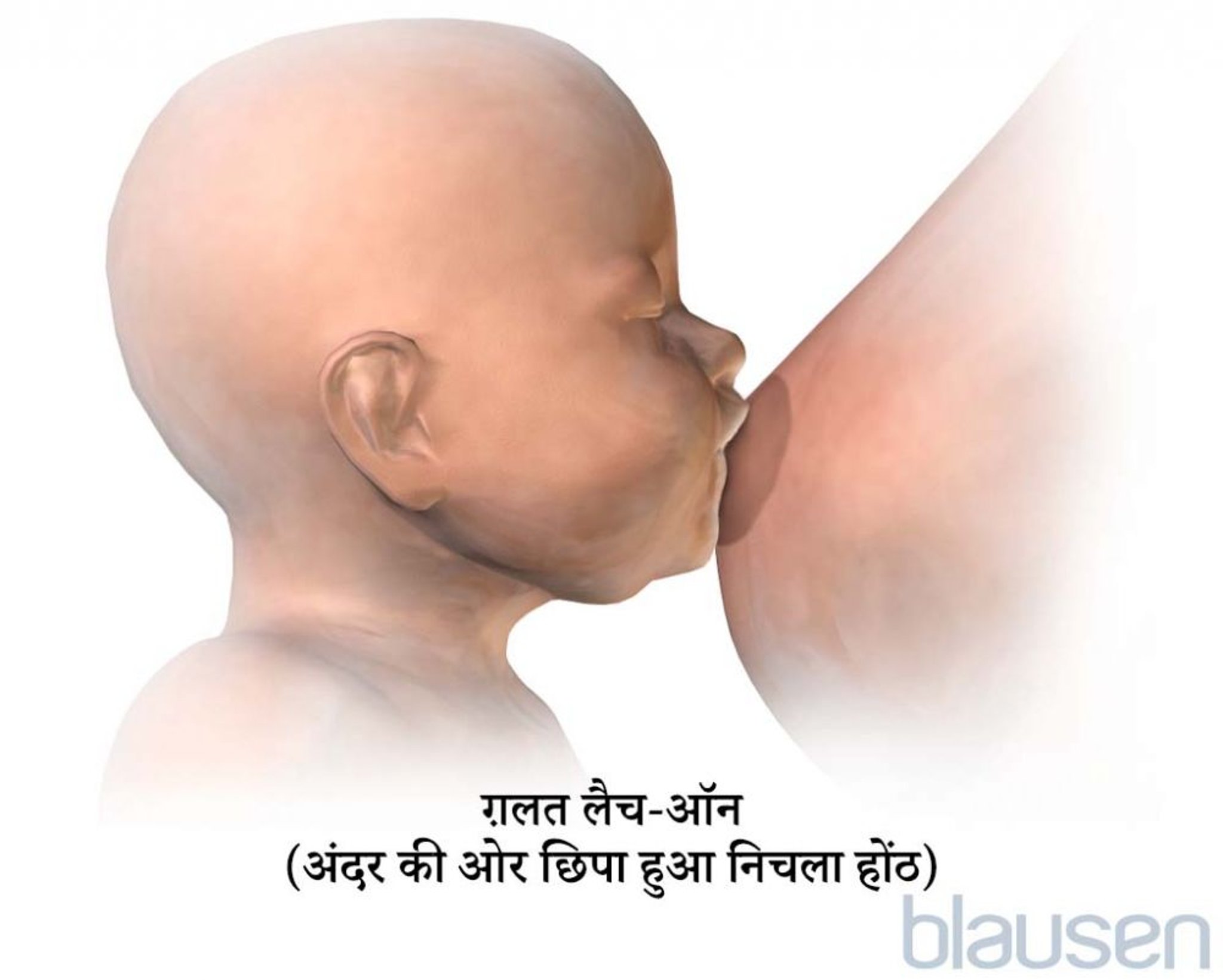 बुनियनेक्टोमी