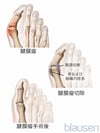 バニオン切除術せつじょじゅつ