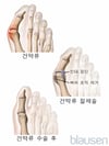 건막류 절제술