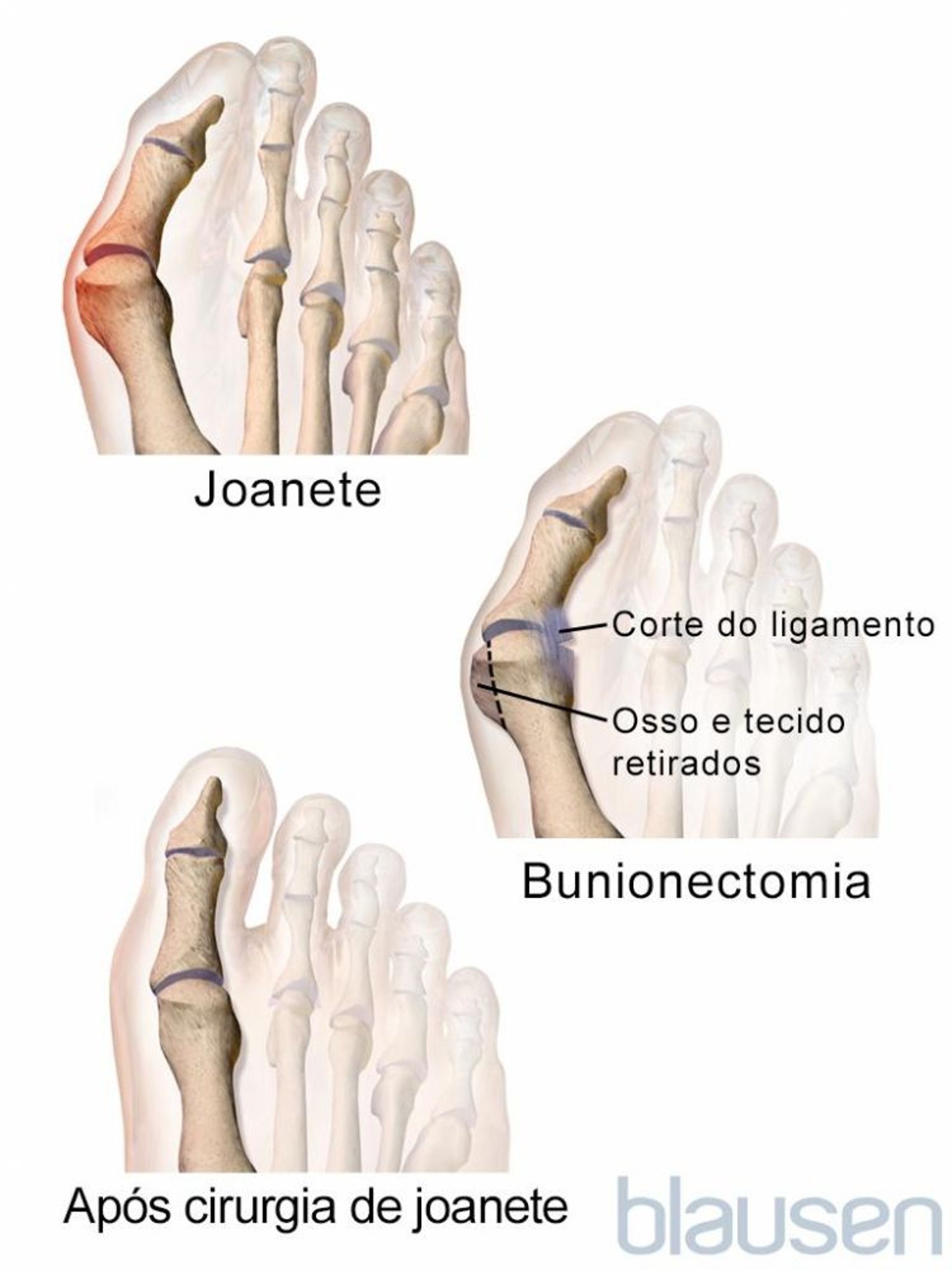 Bunionectomia