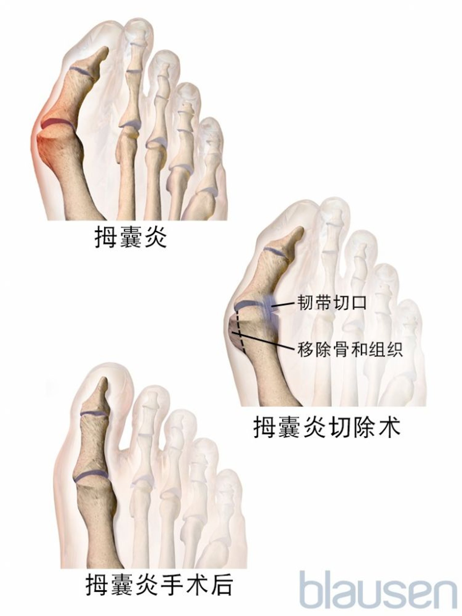 拇囊炎切除术