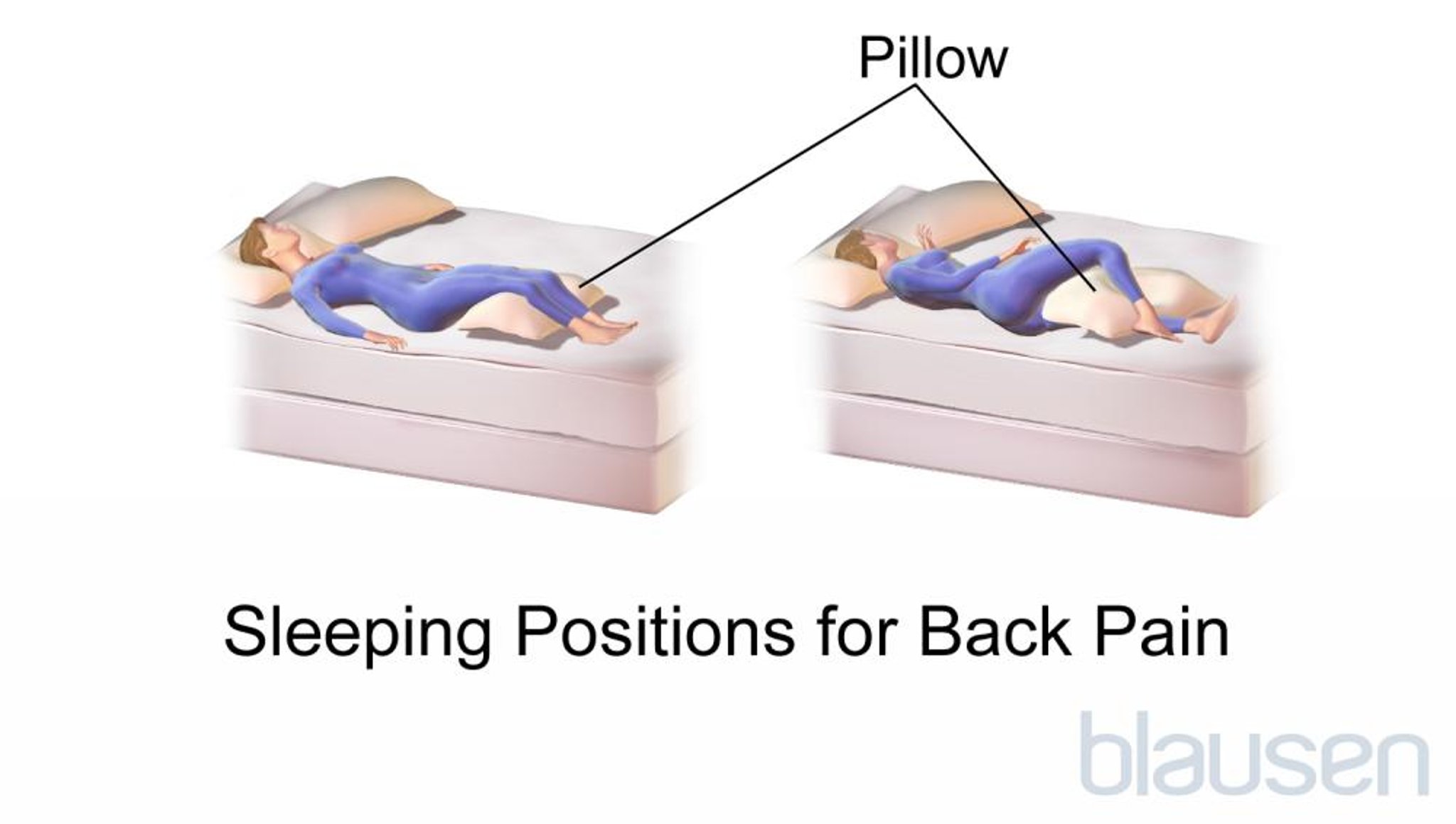 Posizioni durante il sonno per il dolore alla schiena