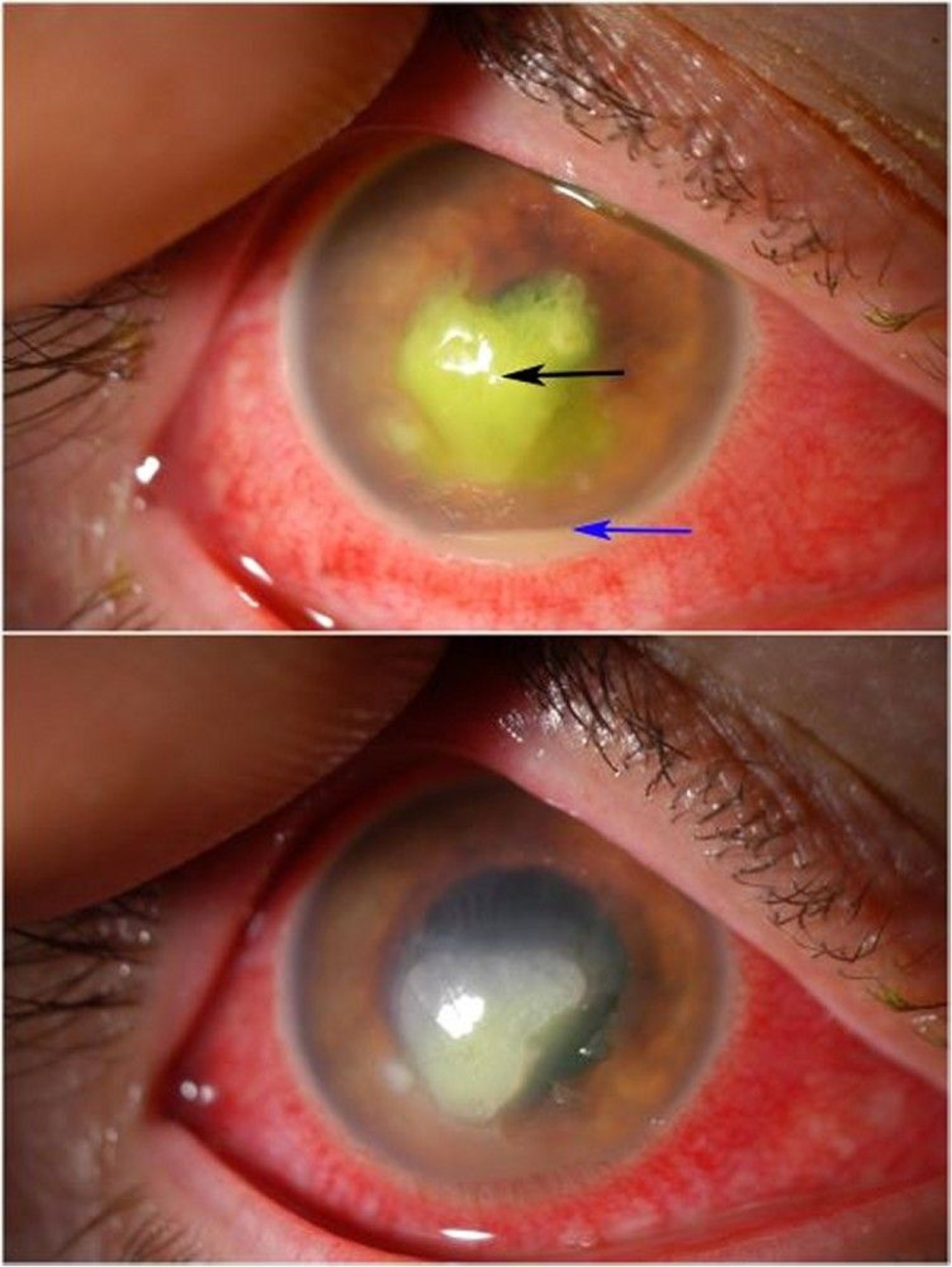 Úlcera corneal bacteriana