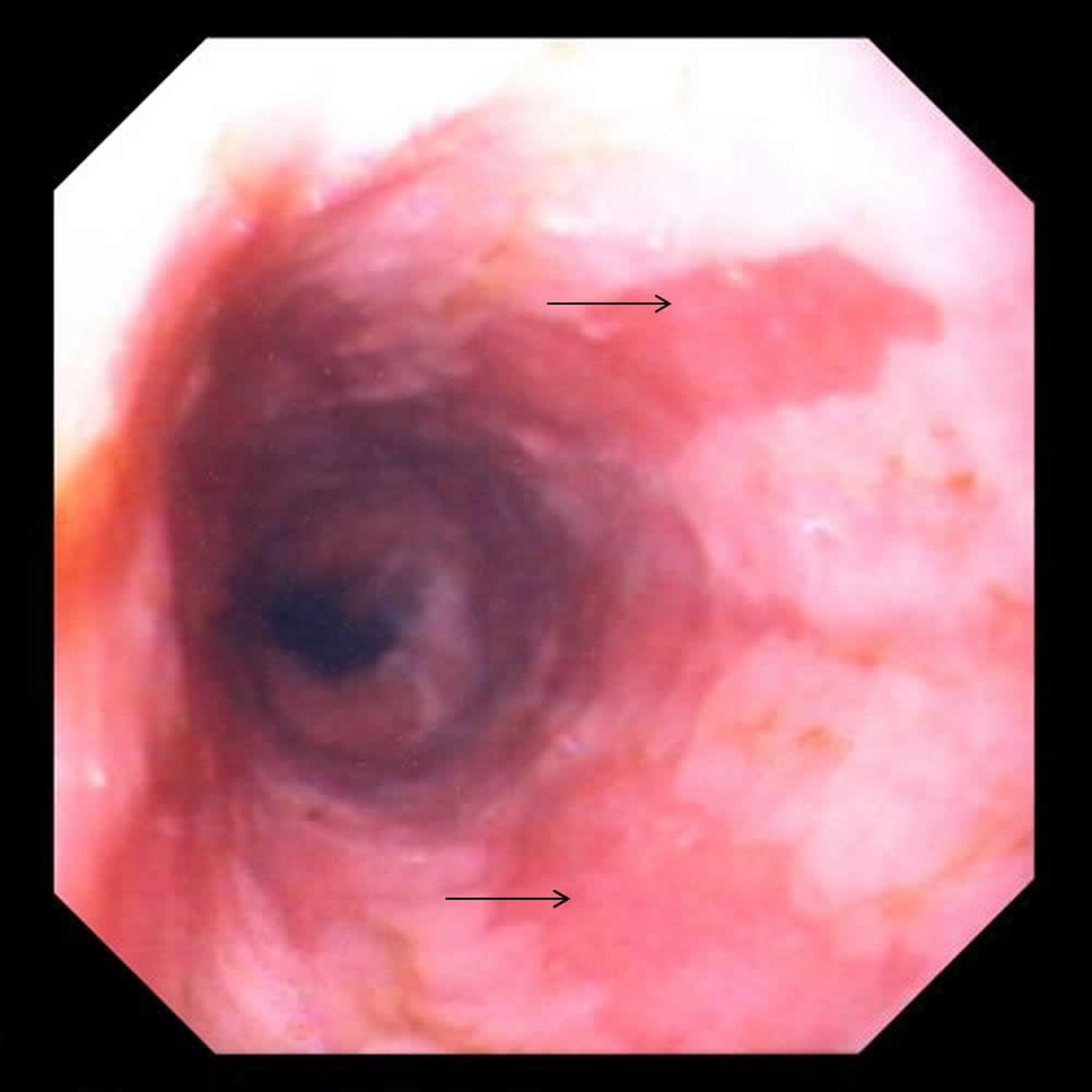 Пищевод Барретта