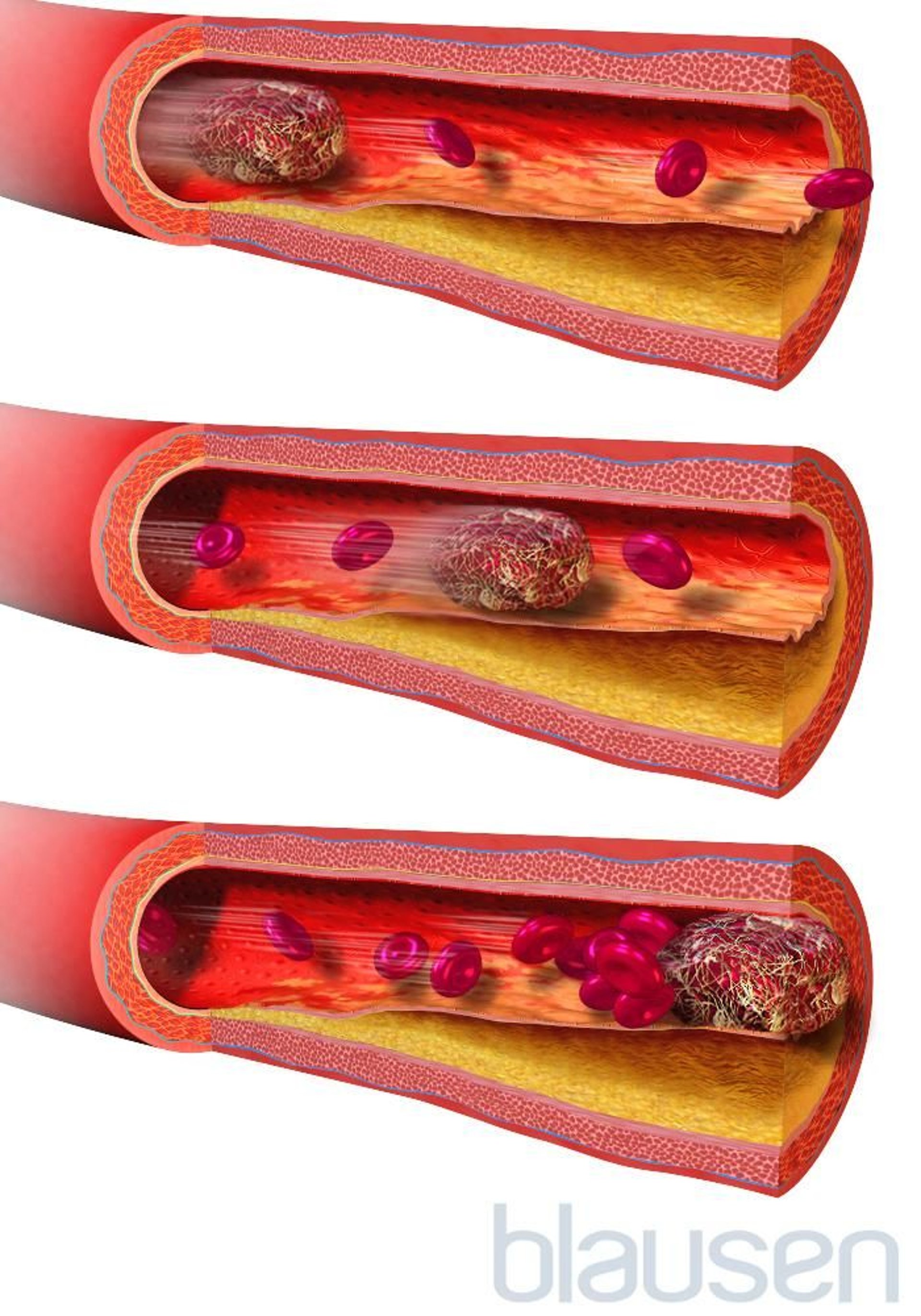 Coagulo di sangue in movimento