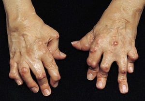 Deformità a bottoniera nell’artrite reumatoide