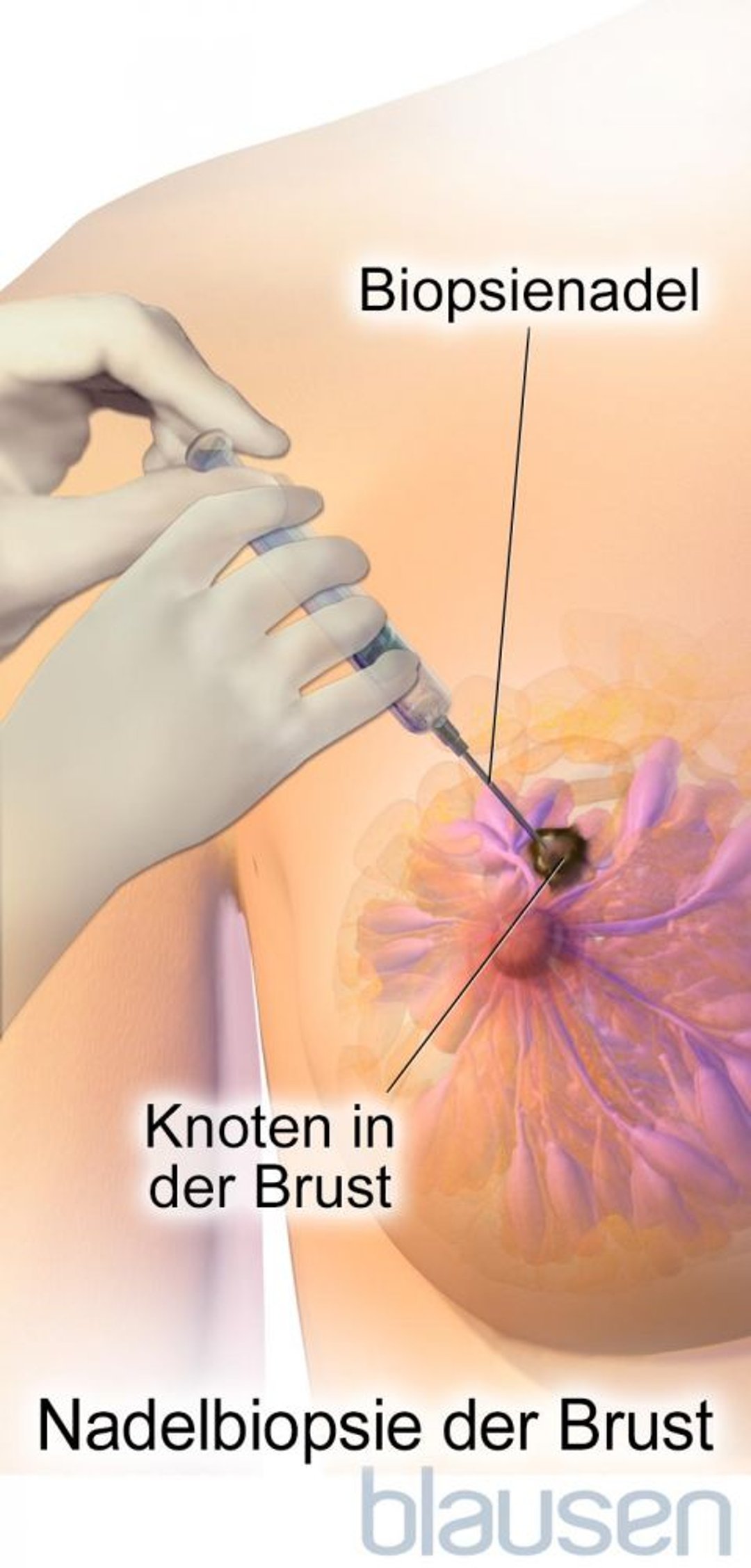 Nadelbiopsie der Brust