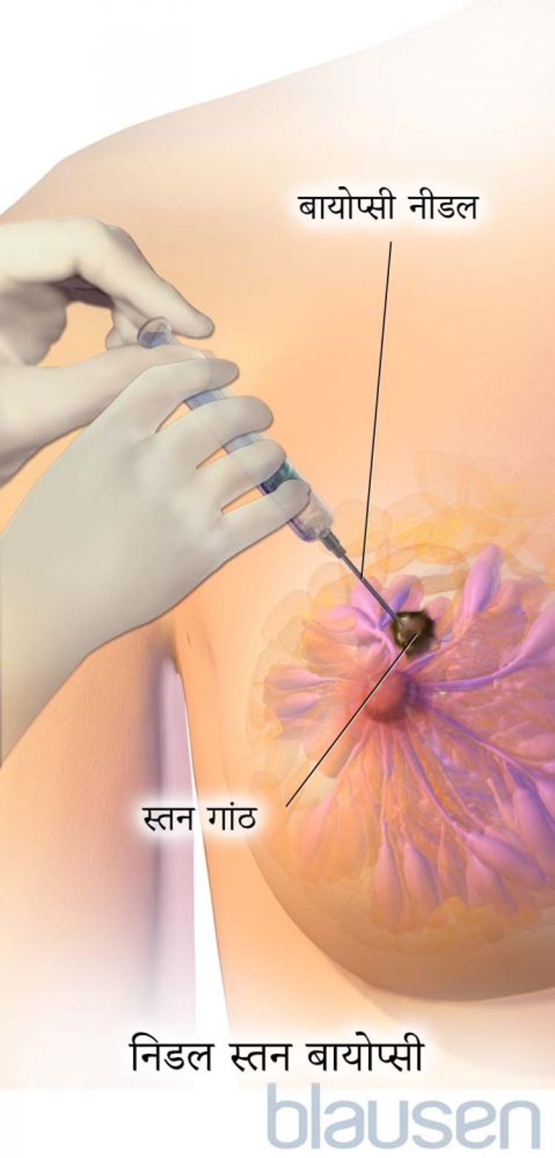 निडल स्तन बायोप्सी